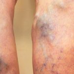 Proširene vene na nogama – Zašto se javljaju