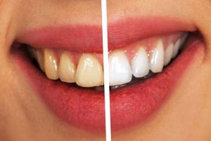 Kako ukloniti zubni kamenac?